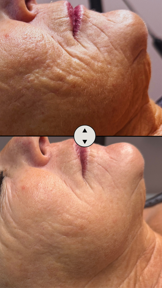 HIFU à Andrézieux-Bouthéon : tout savoir sur le lifting sans chirurgie